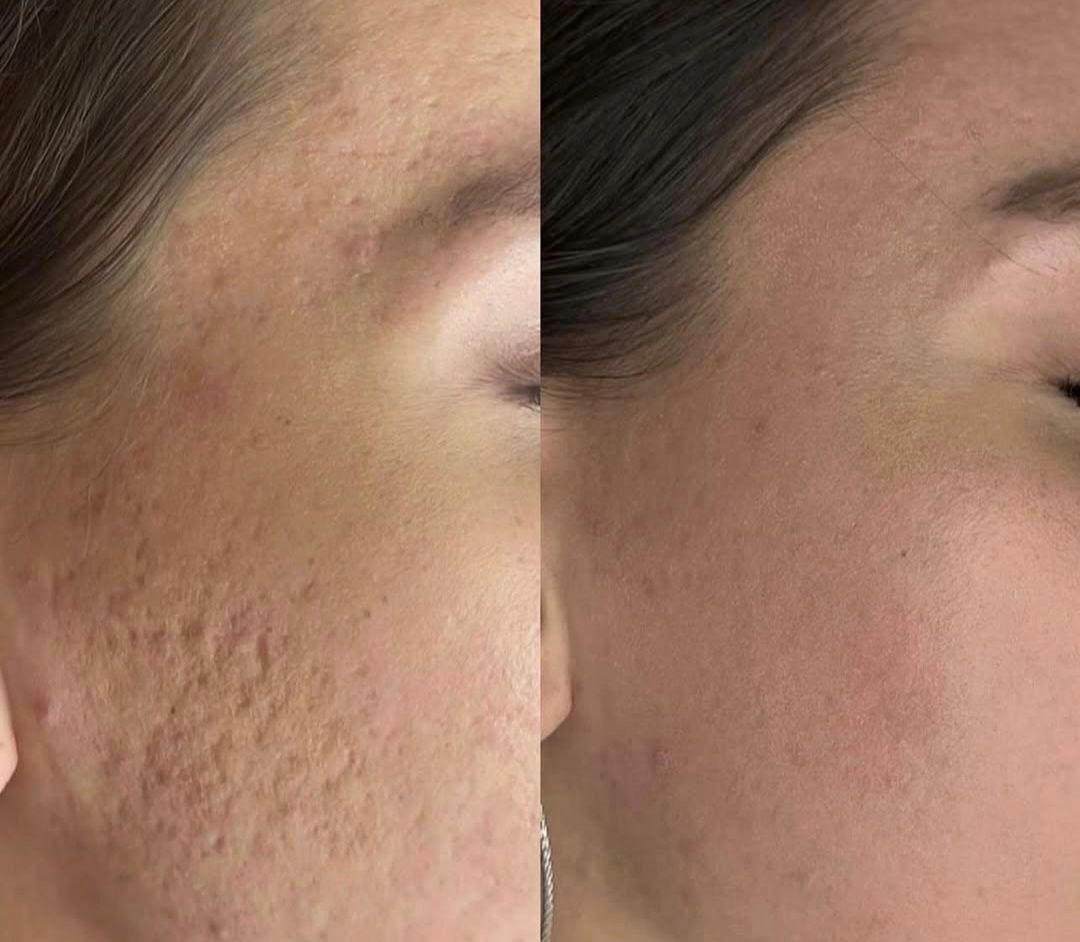 Résultat traitement 2